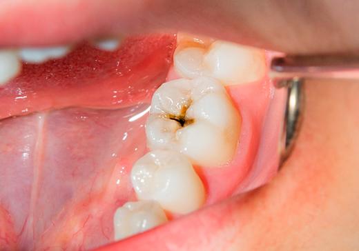Restauración de caries